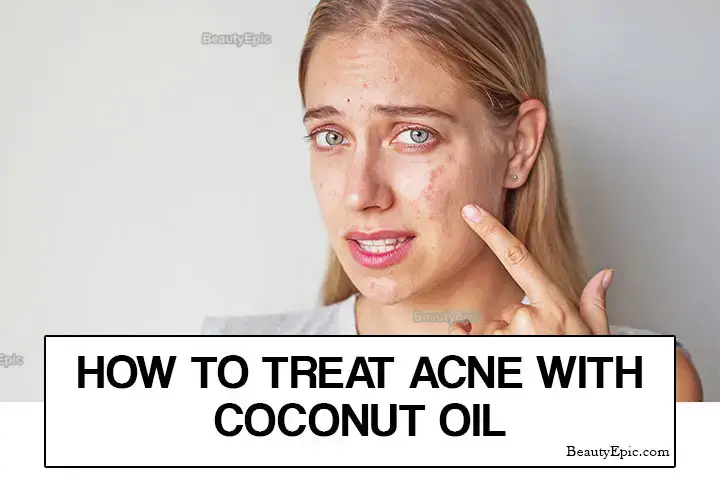 coconut oil for acne treatment